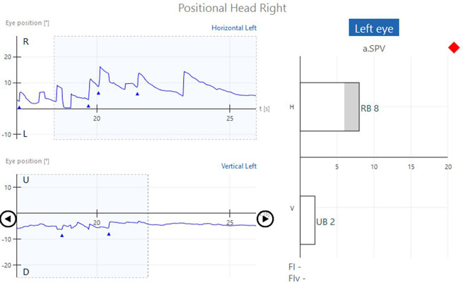 Graphs with eye position in degrees as a function of time in seconds. Four recorded beats of horizontal, right-beating nystagmus, yielding a right-beating nystagmus with an average slow phase velocity of 8. This is above the normal range of 0 to 6. There are also two recorded beats of vertical, up-beating nystagmus, yielding an up-beating nystagmus with an average slow phase velocity of 2. This is within the normal range of 0 to 6.