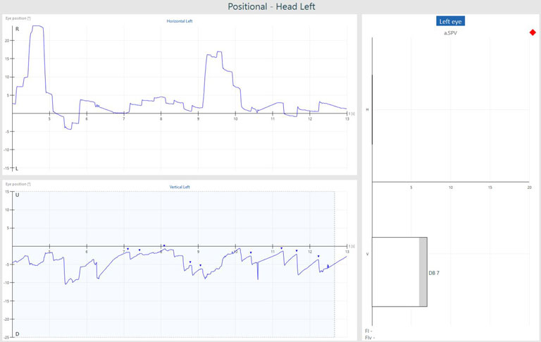Graphs with eye position in degrees as a function of time in seconds. Nine recorded beats of vertical, down-beating nystagmus, yielding a down-beating nystagmus with an average slow phase velocity of 7. This is above the normal range of 0 to 6.