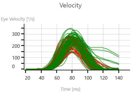 Eye velocities reaching 150 to 250 degrees per second for the left eye and 200 to 300 degrees per second for the right eye.