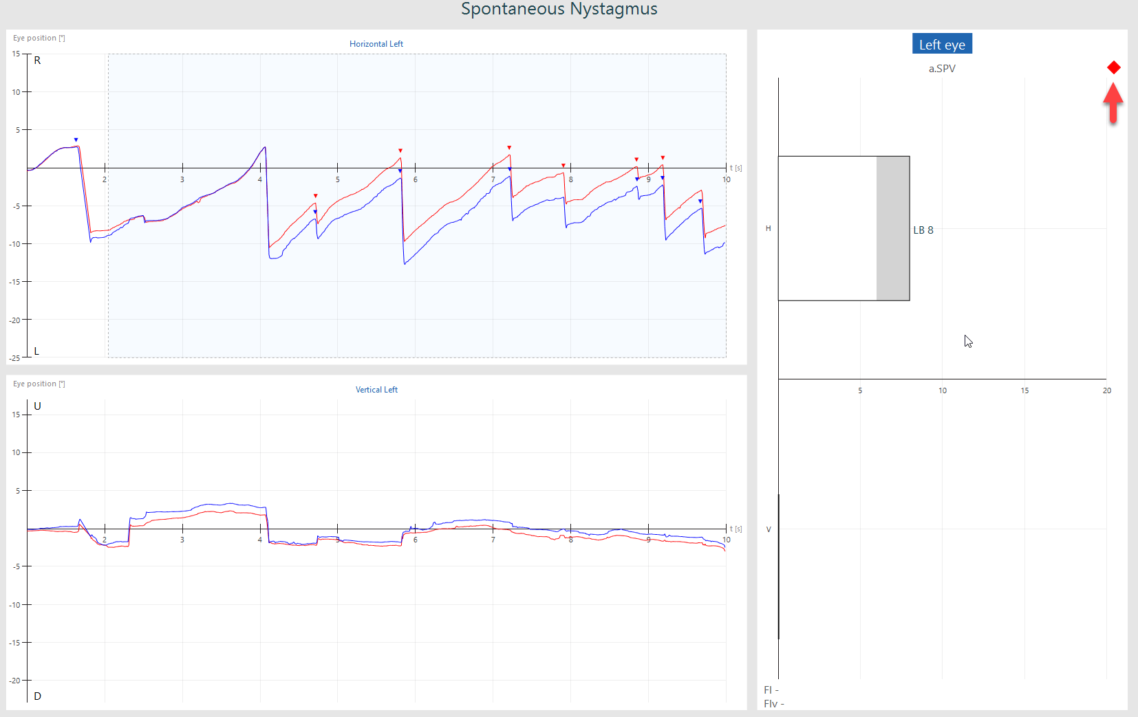 VisualEyes Spontaneous Nystagmus Interacoustics abnormal-urinalysis-babycenter